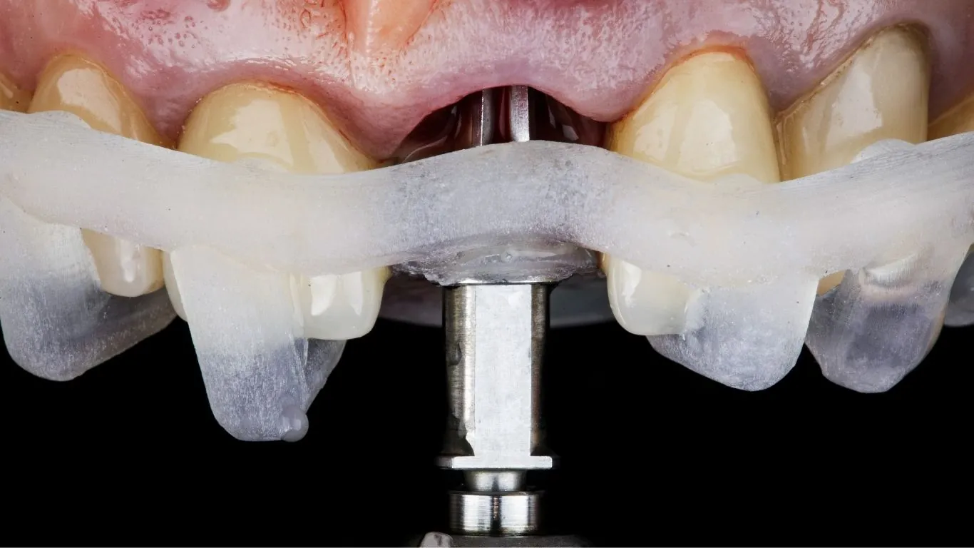 Dental Implants - Implant placement procedure