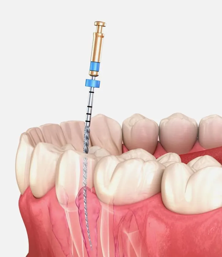 Root Canal Treatment - Endodontic procedure