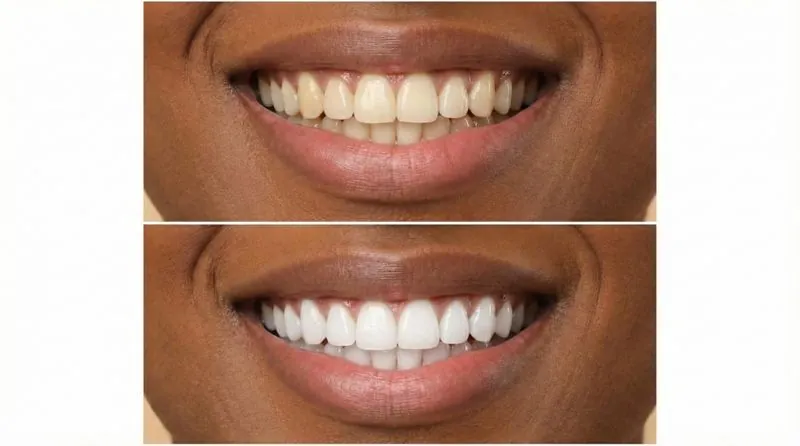 Teeth Whitening - Professional whitening results