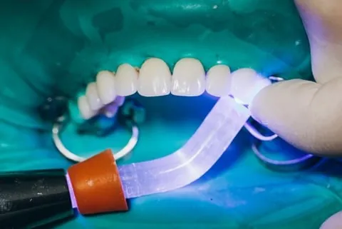 Composite Bonding - Tooth reshaping results