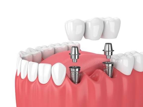 Dental Implants Procedure