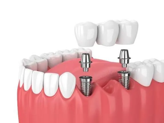 Dental Implants Procedure